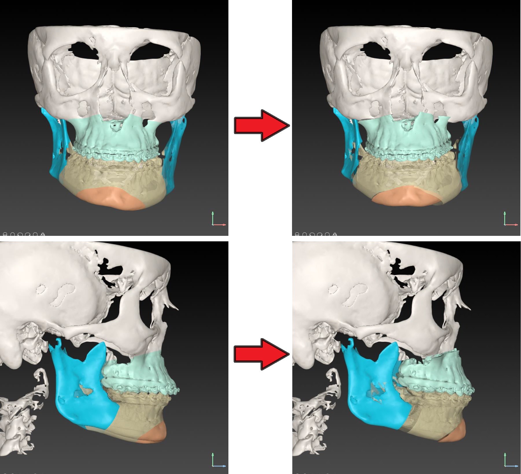 Digitale 3D-planning van de operatie