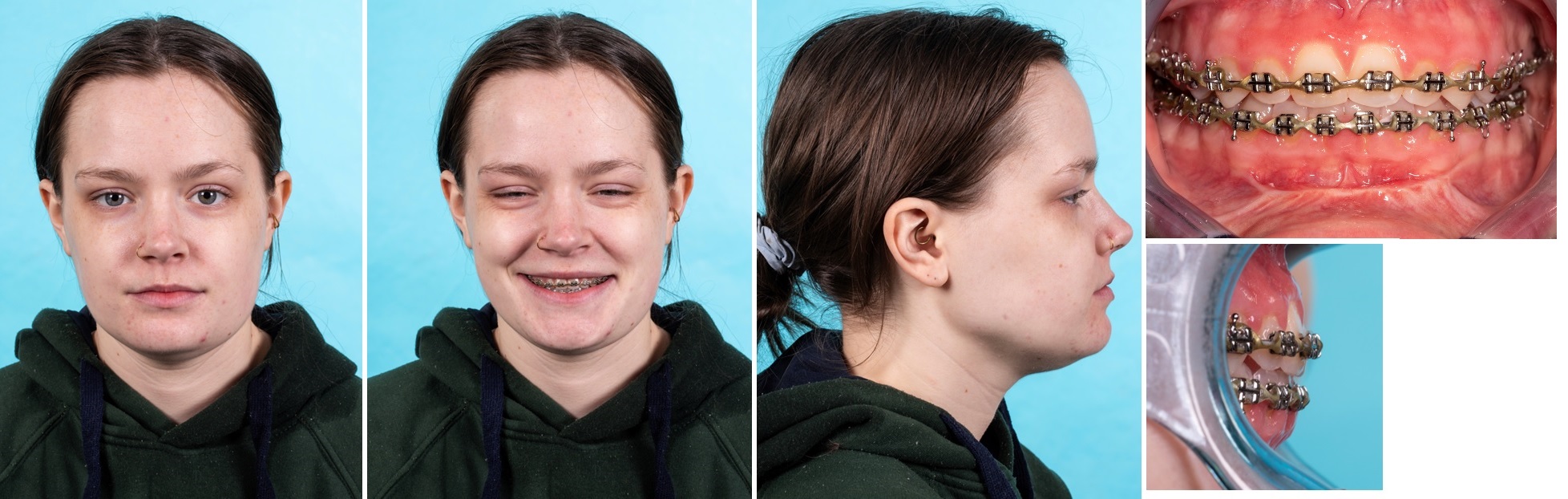 Foto&rsquo;s na de operatie (postoperatieve orthodontie nog bezig, circa 3 maanden na operatie)