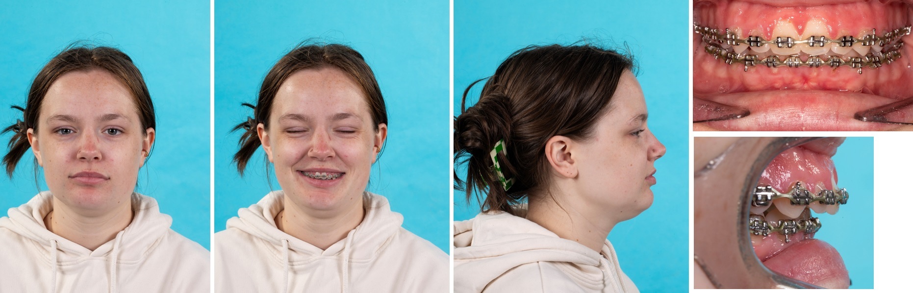 Foto&rsquo;s voor de operatie, er is sprake van een asymmetrie van de bovenkaak en onderkaak