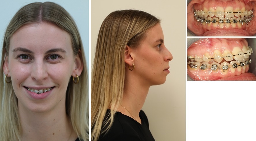 Foto&rsquo;s na de operatie (postoperatieve orthodontie nog bezig, circa 3 maanden na operatie)