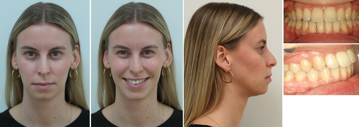 Foto&rsquo;s na de operatie (circa 1 jaar na operatie, de orthodontische behandeling is afgerond)