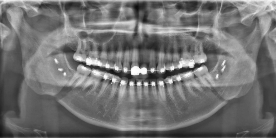 Röntgen beeld na operatie