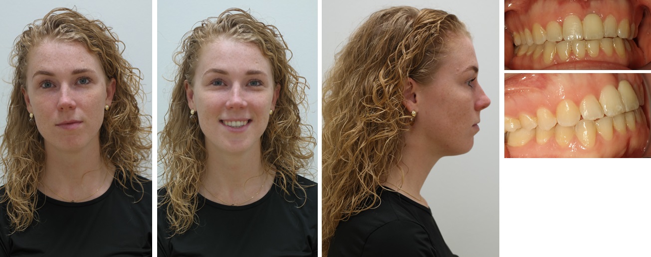 Foto’s na de operatie (postoperatieve orthodontie afgerond, circa 1 jaar na operatie)