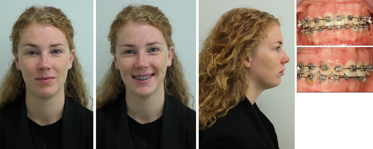 Foto’s voor de operatie, er is sprake van een terugliggende onderkaak