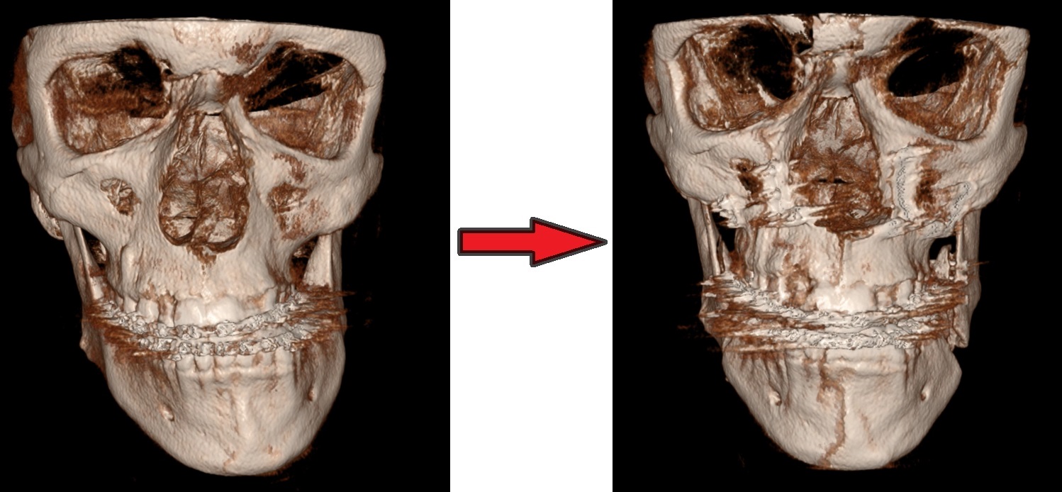 Röntgen beeld voor en na operatie