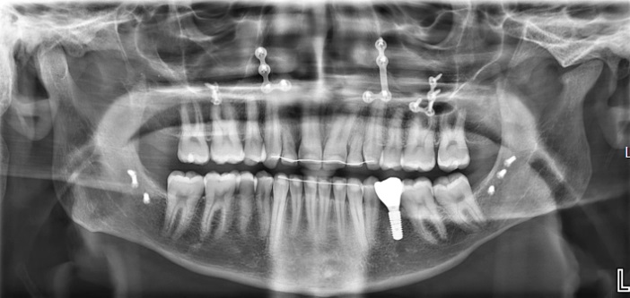 Röntgen beeld na operatie. Er is na operatie nog een implantaat geplaatst ter vervanging van een kleine kies in de onderkaak