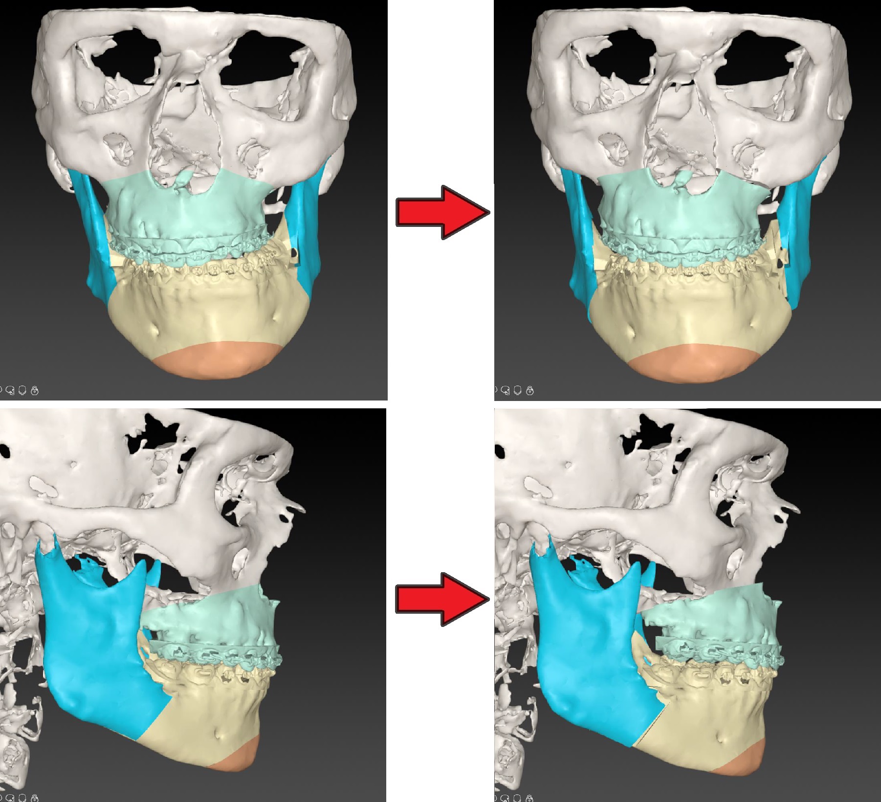 Digitale 3D-planning van de operatie