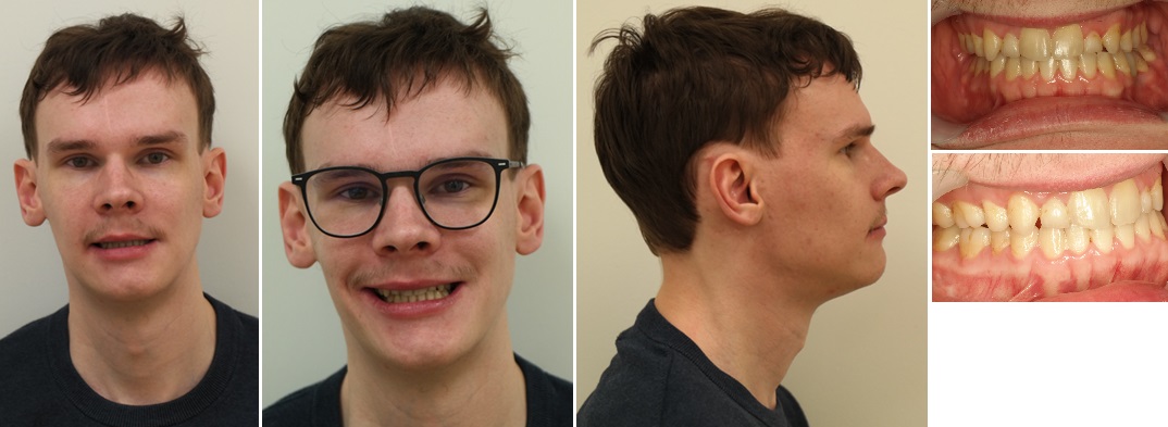 Foto&rsquo;s na de operatie (postoperatieve orthodontie afgerond, circa 1 jaar na operatie)