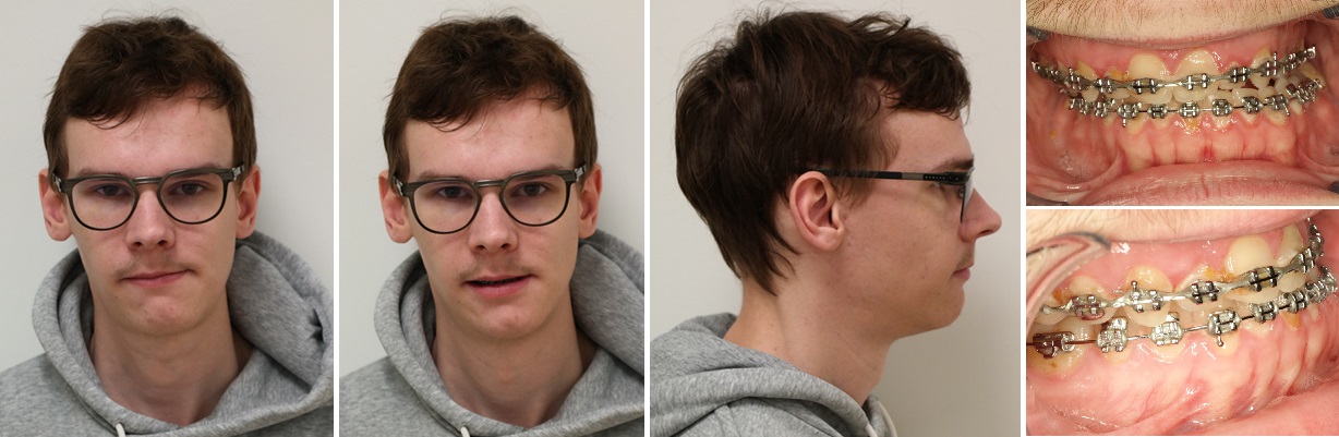 Foto&rsquo;s voor de operatie, er is sprake van een asymmetrie