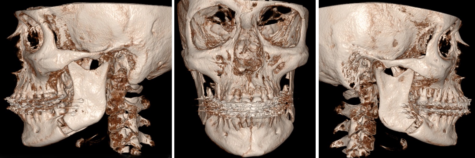 Röntgen beeld na operatie