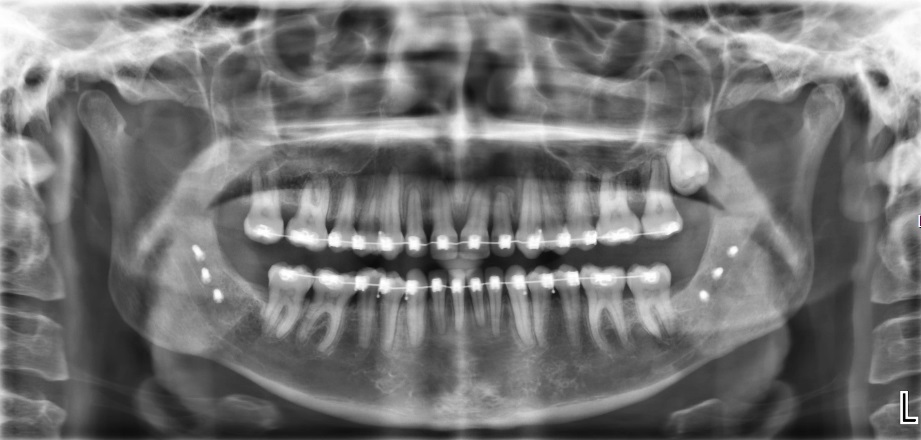 Röntgen beeld na operatie