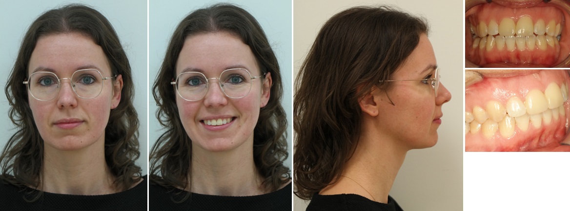 Foto’s na de operatie (circa 1 jaar na operatie)