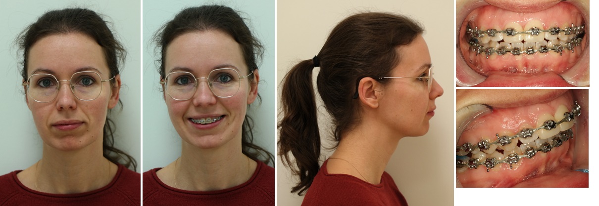 Foto’s voor de operatie, er is sprake van een terugliggende onderkaak