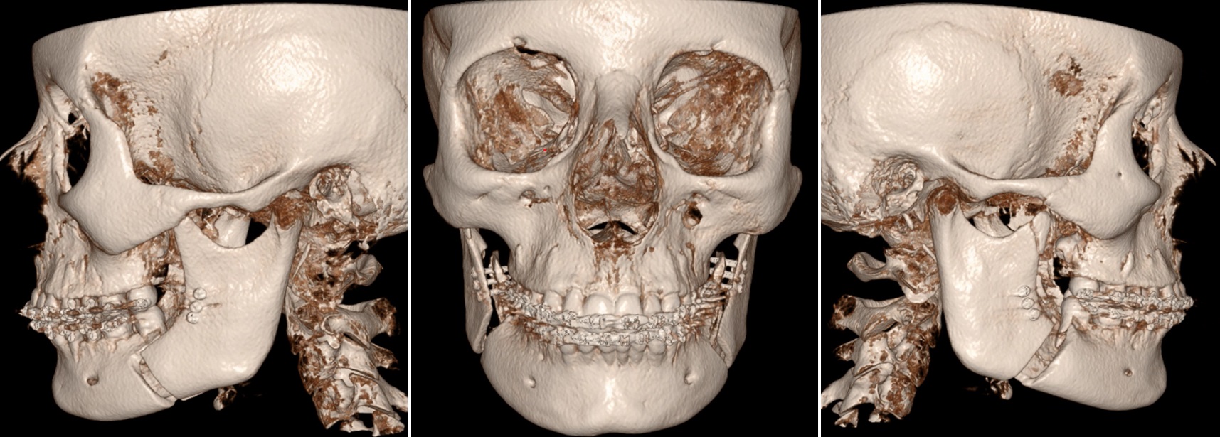 Röntgen beeld na operatie