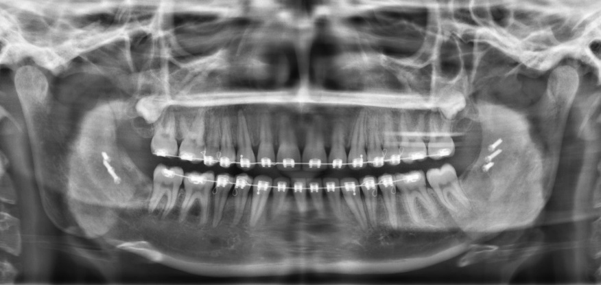 Röntgen beeld na operatie