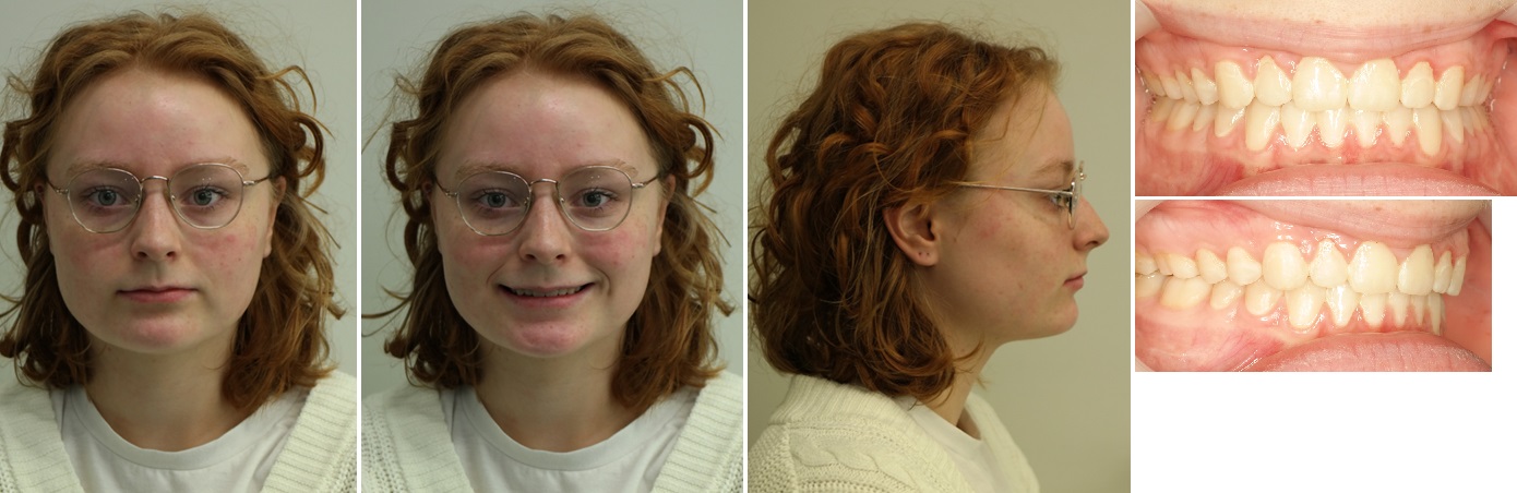 Foto&rsquo;s na de operatie (circa 1 jaar na operatie)