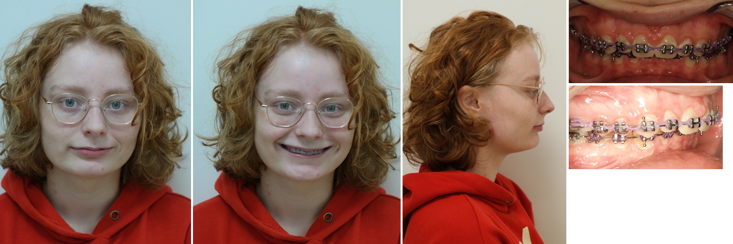 Foto&rsquo;s voor de operatie, er is sprake van een terugliggende onderkaak