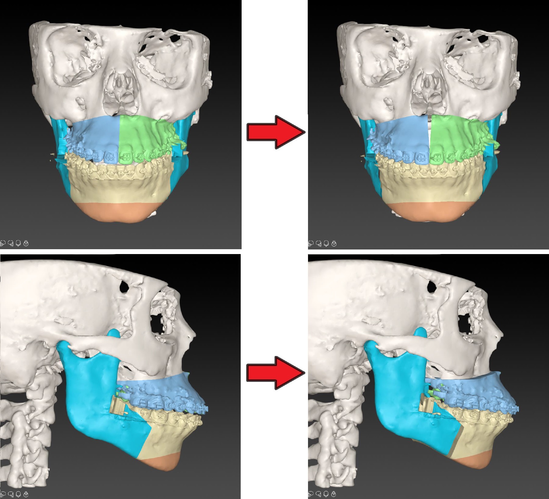 Digitale 3D-planning van de operatie