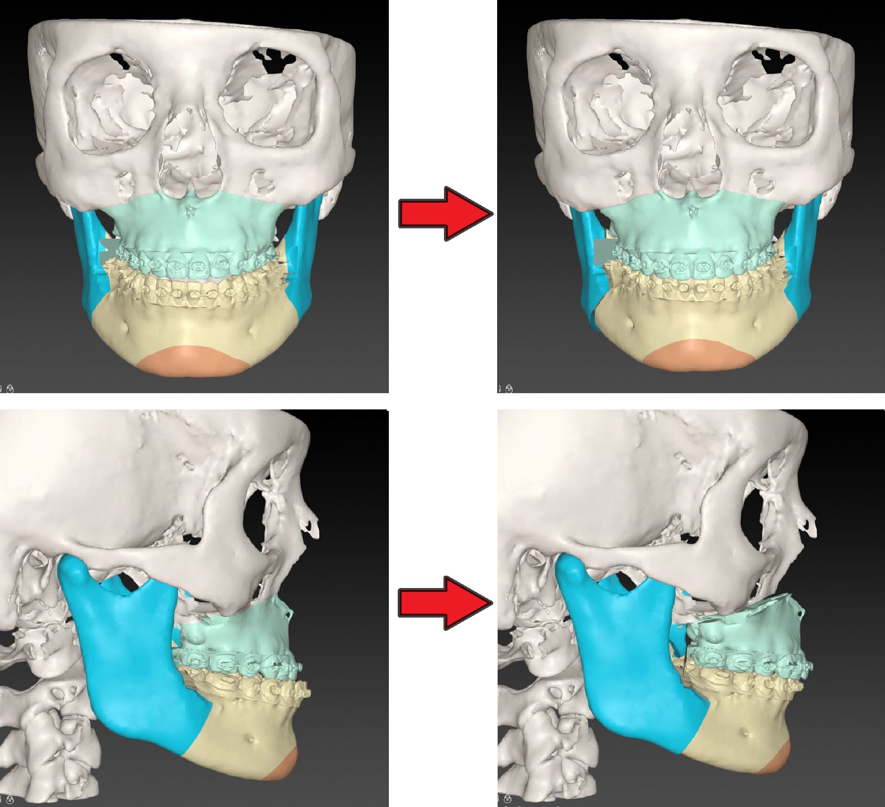 Digitale 3D-planning van de operatie