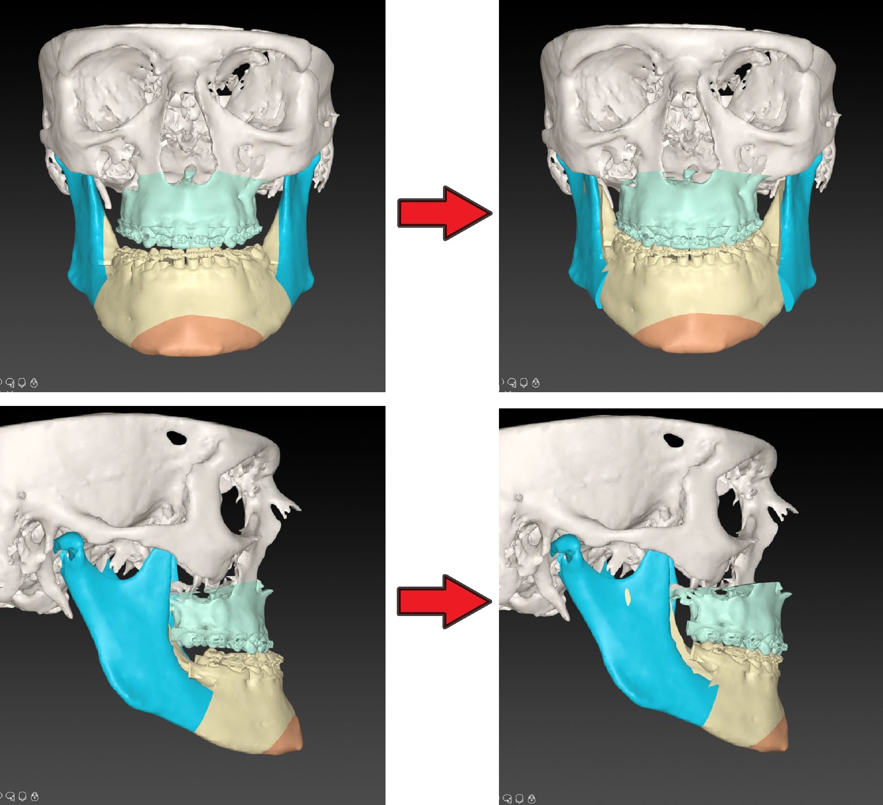 Digitale 3D-planning van de operatie