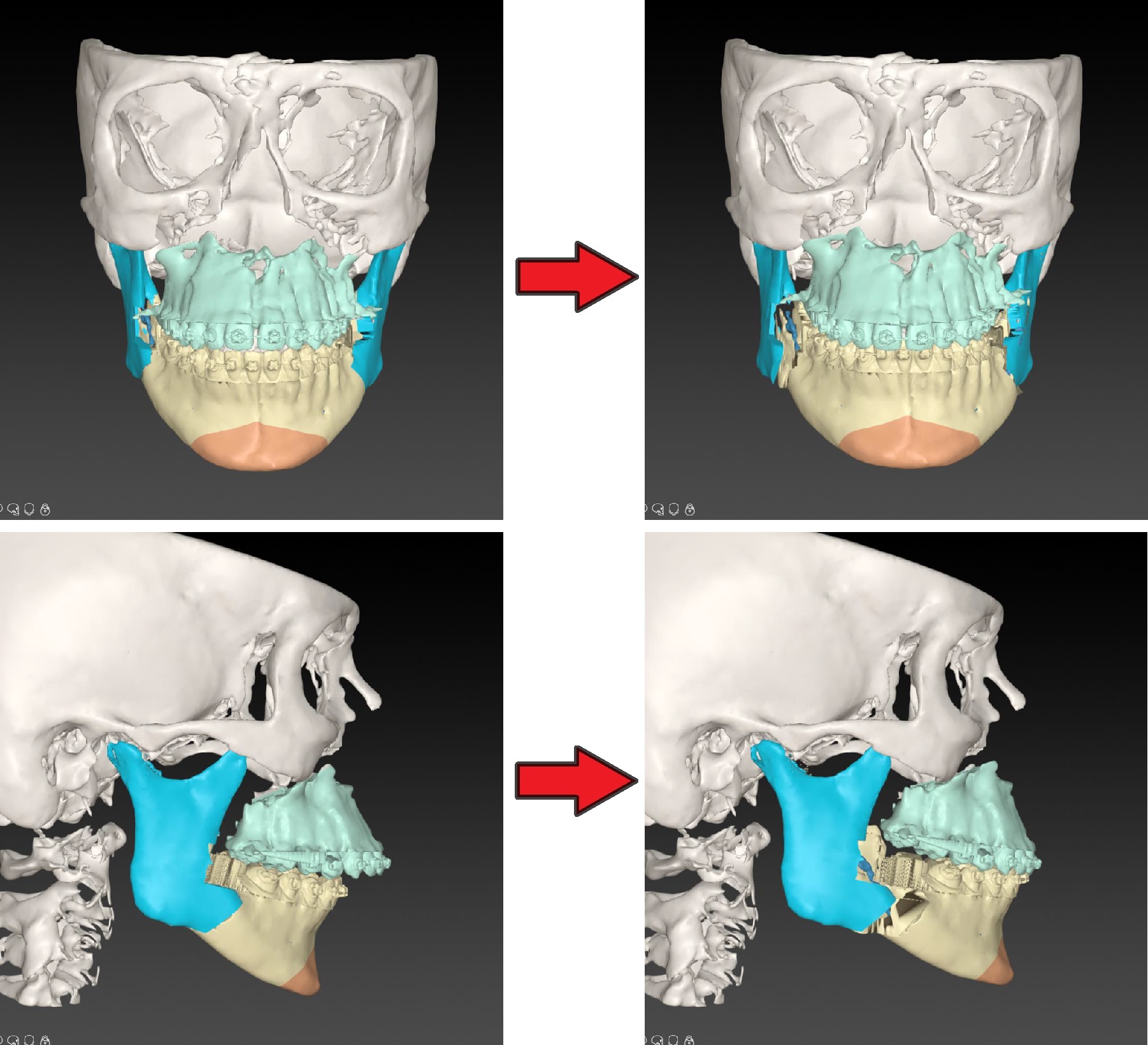 Digitale 3D-planning van de operatie