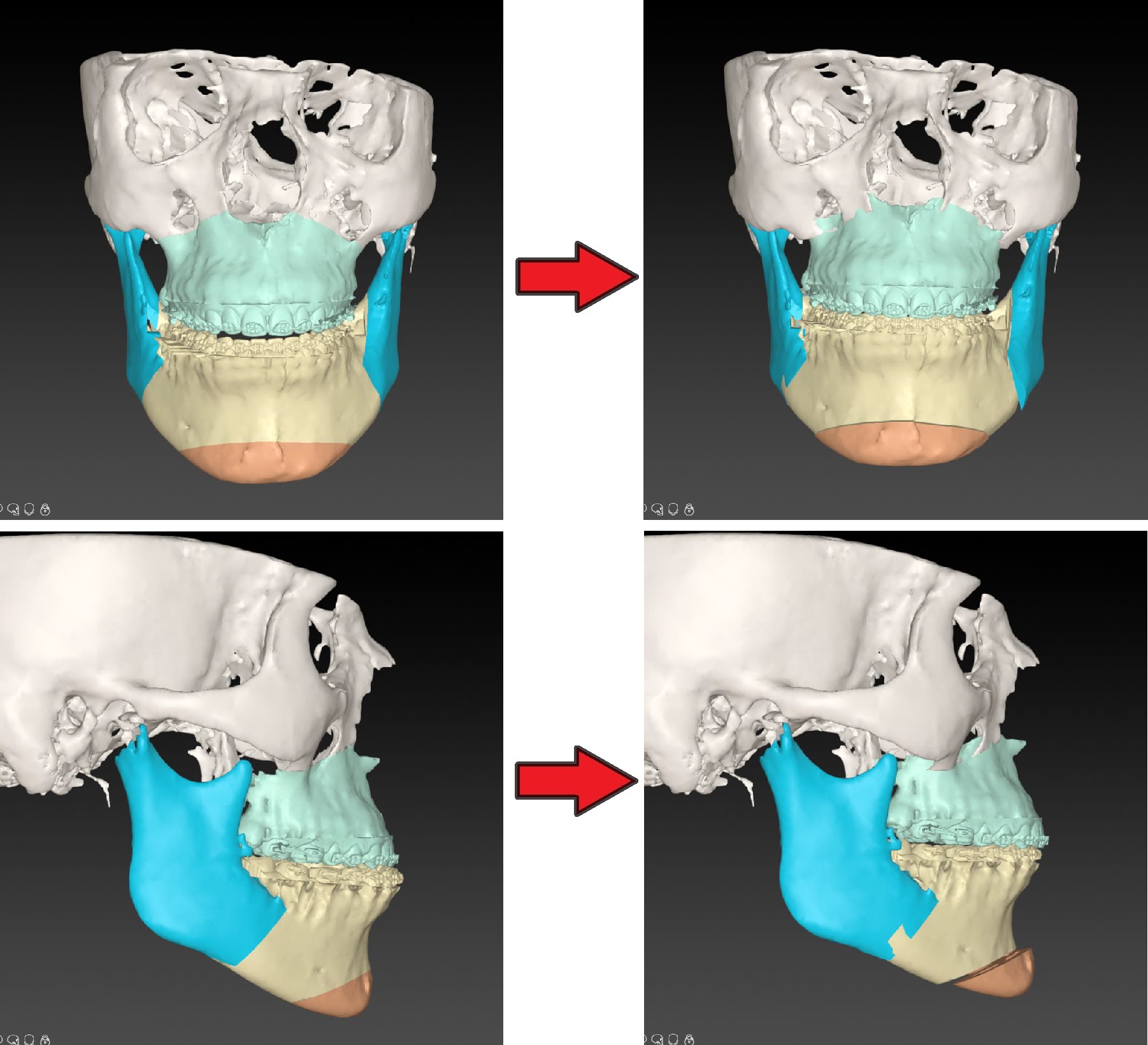 Digitale 3D-planning van de operatie