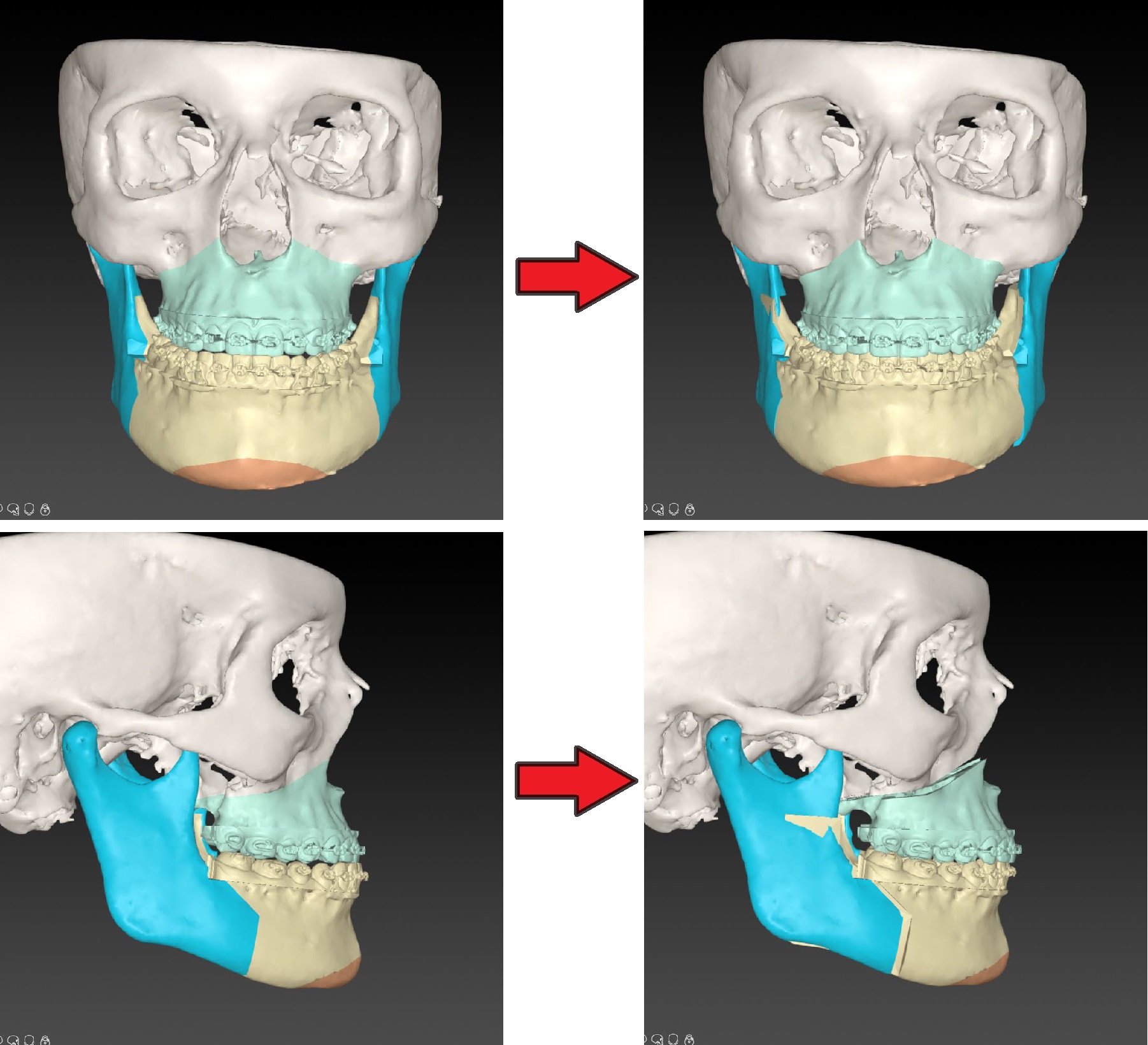 Digitale 3D-planning van de operatie