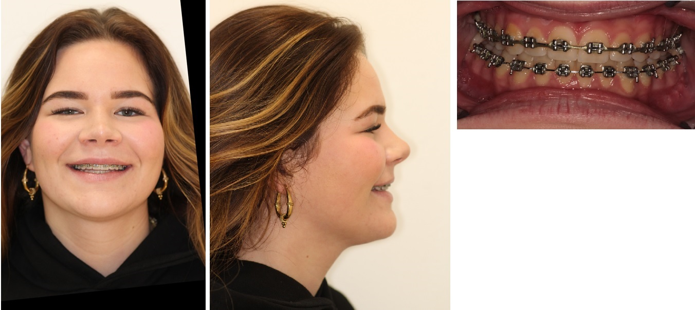 Foto&rsquo;s na de operatie (postoperatieve orthodontie nog bezig, circa 3 maanden na operatie)